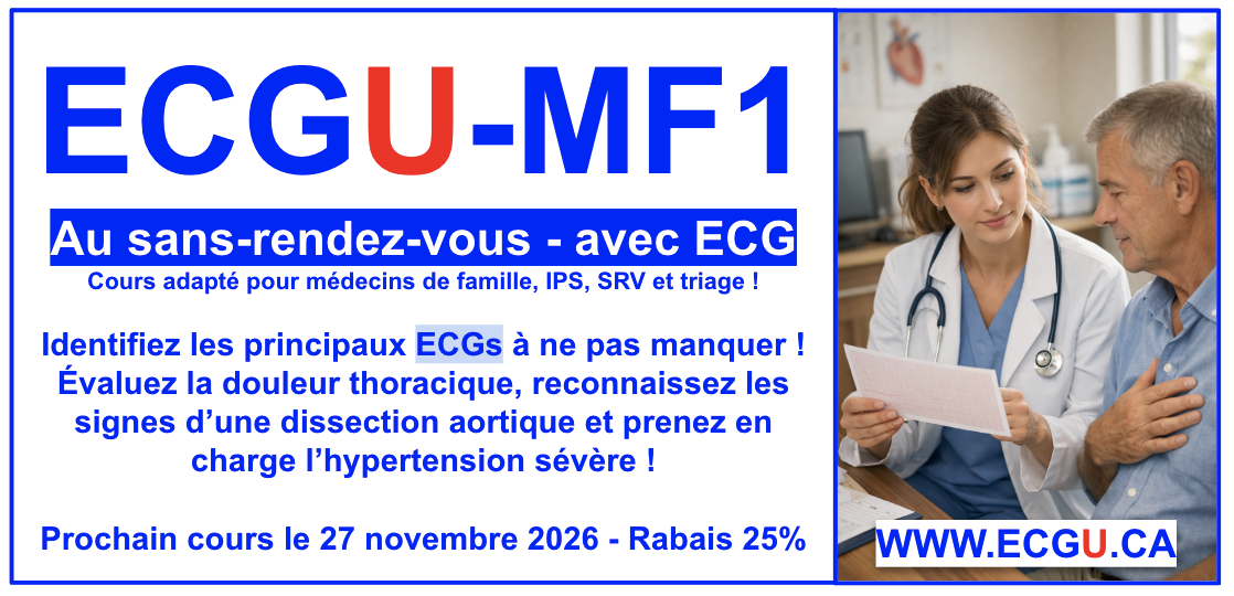 MF1  - au SRV avec un ECG !